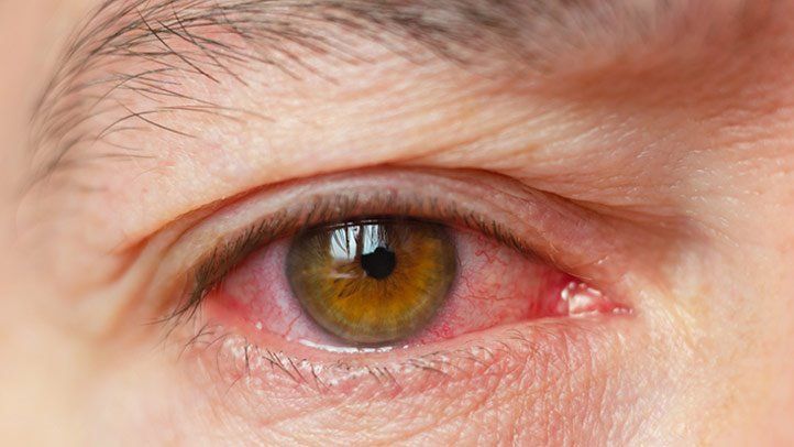 Dry eye and ocular allergy treatment